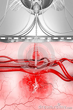 A malaria-infected mosquito transmits malaria pathogens to the human bloodstream during mosquito bites Cartoon Illustration