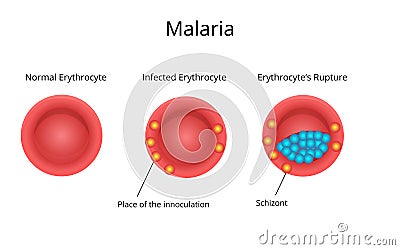 Malaria infection.Normal erythrocyte with the infected blood cell Vector Illustration