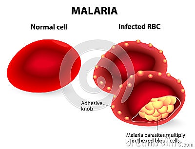 Malaria. Normal and infected red blood cells Vector Illustration