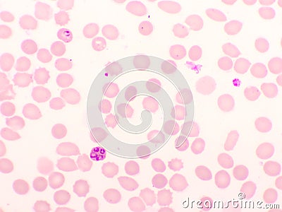 Malaria parasite in red blood cells Stock Photo