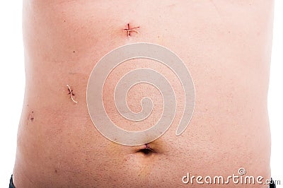 Male abdomen with fresh stitches after gallbladder removal Stock Photo