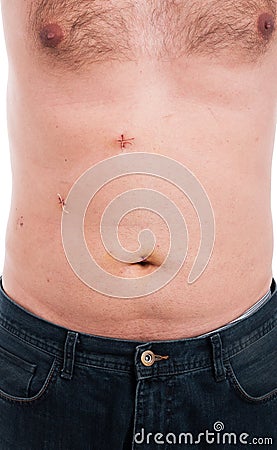 Male abdomen with stitches after gallbladder removal Stock Photo