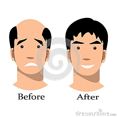 Male baldness pattern stages set. Vector Illustration