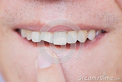 Male broken teeth damaged cracked front tooth Stock Photo