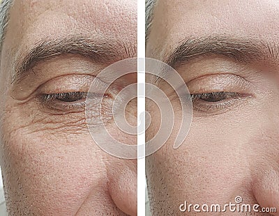male face removal wrinkles effect biorevitalization before and after treatments Stock Photo