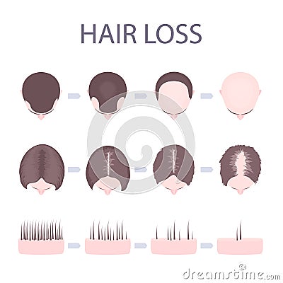 Male and female hair loss Vector Illustration