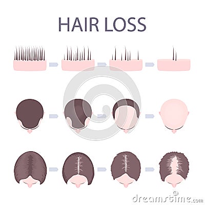 Male and female hair loss Vector Illustration