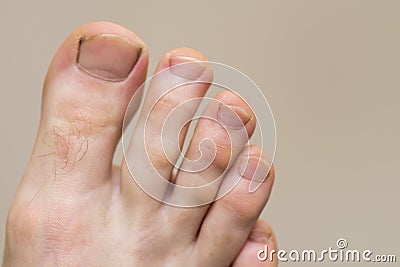 Male foot with symptoms of fungal nail plate. Nails on man`s legs. Caucasian foot with dirty and nails Stock Photo