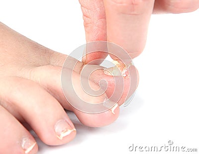 Male foot and toes with damaged nail Stock Photo