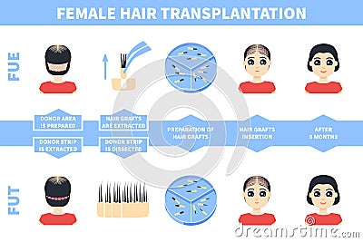 Male hair tranplantation with FUE, FUT methods Vector Illustration