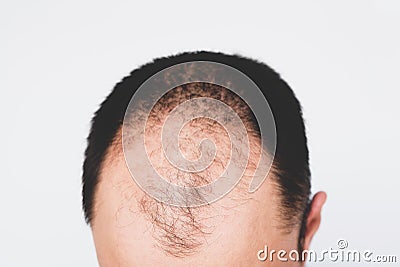 Male pattern hair loss problem concept. Baldness, alopecia in males Stock Photo