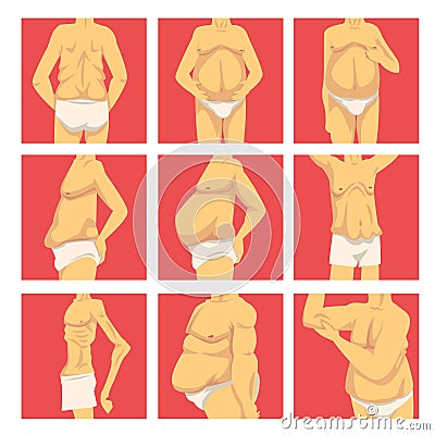 Male Torso with Sagging Belly Set, Human Body After Weight Loss, Obesity and Unhealthy Eating Problems Vector Vector Illustration