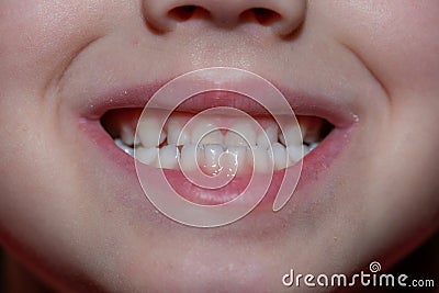 Malocclusion of a child, close-up on the front teeth of a child Stock Photo