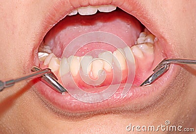 Malocclusion. Crowding of the teeth Stock Photo