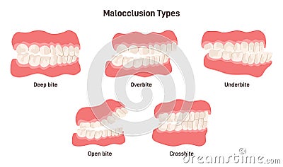 Malocclusion types set. Human crooked teeth. Misalignment or incorrect Vector Illustration