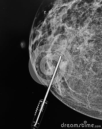 Mammography biopsy needle pathological zone Stock Photo