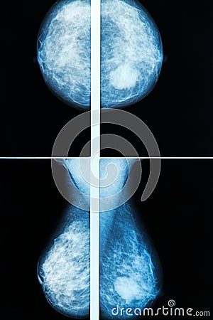 Mammography Stock Photo