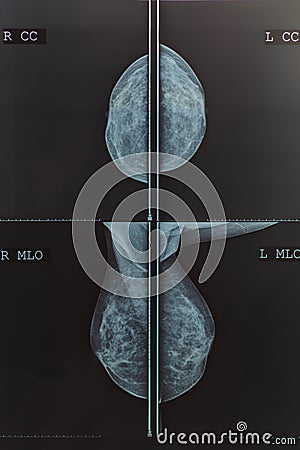Mammography breast scan X-ray image Stock Photo