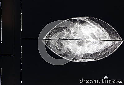 Mammography image on screen Editorial Stock Photo
