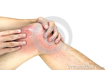 Man apply lotion on sunburnt knee skin, on white background Stock Photo