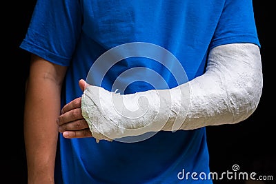 Man with broken arm wrapped medical cast plaster. Fiberglass cast covering the wrist, arm, elbow after sport accident, isolated on Stock Photo