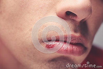 Man with cold sore Stock Photo