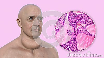 A man with enlarged thyroid gland, 3D illustration, and micrograph toxic goiter Cartoon Illustration