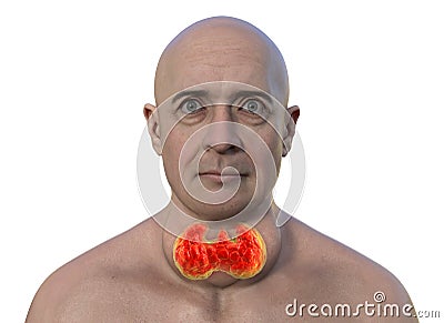 A man with enlarged thyroid gland, 3D illustration Cartoon Illustration