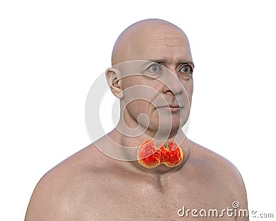 A man with enlarged thyroid gland, 3D illustration Cartoon Illustration