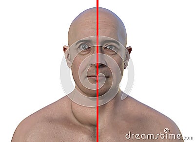 A man with enlarged thyroid gland, 3D illustration Cartoon Illustration