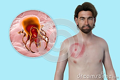 A man with erythema migrans, a characteristic rash of Lyme disease caused by Borrelia burgdorferi, 3D illustration Cartoon Illustration