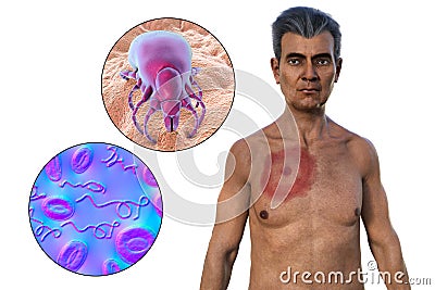 A man with erythema migrans, a characteristic rash of Lyme disease caused by Borrelia burgdorferi, 3D illustration Cartoon Illustration