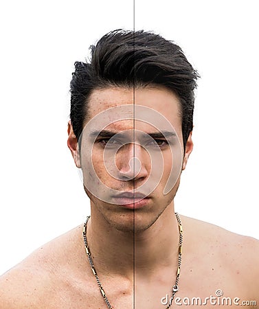 Man Face with Pimple and Flawless Sides on White Stock Photo