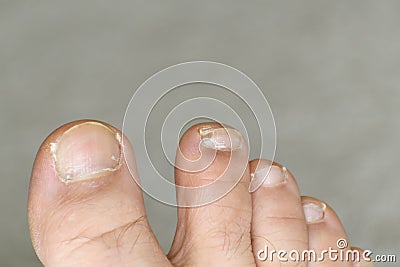 Man foot toes closeup with nail damage. Ugly feet Stock Photo