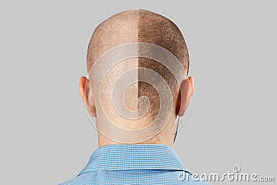 Man before and after hair loss, transplant on background. back view Stock Photo