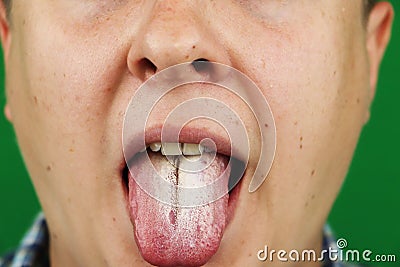 Man with halitosis for Candida albicans on tongue Stock Photo