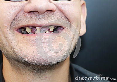 The man has rotten teeth, teeth fell out, yellow and black teeth hurt. Poor teeth condition, erosion, caries. The doctor prepares Stock Photo
