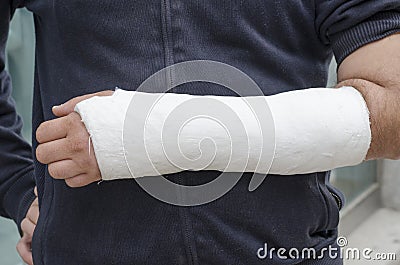 Man with his broken arm. Arm in cast. Stock Photo