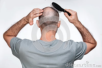 A man holds his hands to his bald head, combing alopecia foci with a comb. Rear view. The concept of baldness and male alopecia Stock Photo