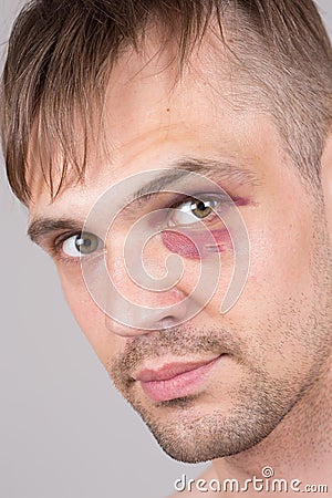 Man with an injured eye. Closeup Stock Photo