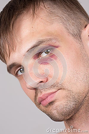 Man with an injured eye. Closeup Stock Photo