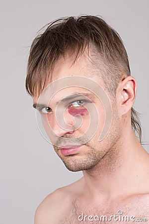 Man with an injured eye. Closeup Stock Photo