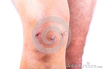 Man knee after arthroscopic surgery Stock Photo