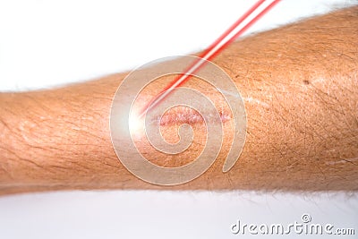 Man leg and laser beam during scar removal treatment. Laser resurfacing of scars Stock Photo