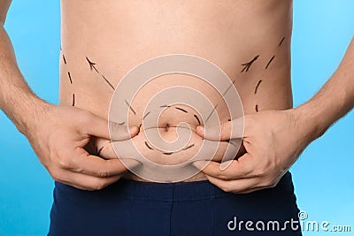 Man with marks on belly for cosmetic surgery operation against blue background Stock Photo