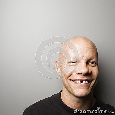 Man with missing tooth. Stock Photo