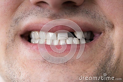 Man With Missing Tooth Stock Photo