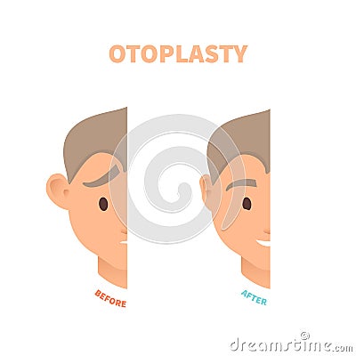 Man before and after otoplasty ear surgery treatment Vector Illustration