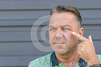 Man pointing to an inflamed eye caused by bacteria Stock Photo