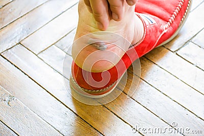 The man reaches out to a large calluses or blister with fluid on foot near the heel after removing the shoes. The emergence of cal Stock Photo